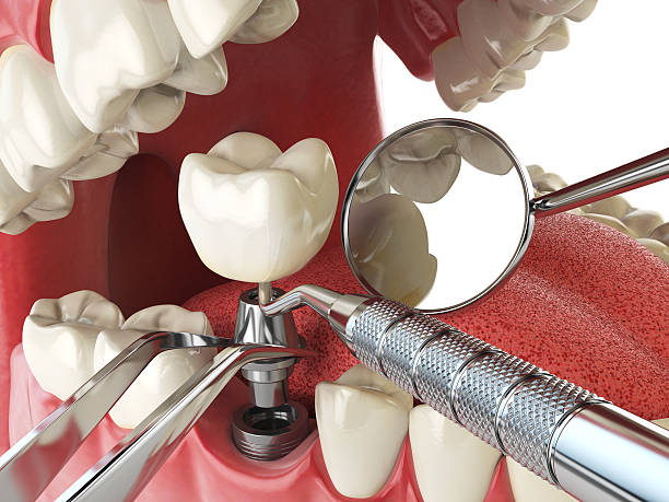 Best Emergency Denture Repair in Lake City, MN